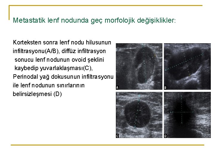 Metastatik lenf nodunda geç morfolojik değişiklikler: Korteksten sonra lenf nodu hilusunun infiltrasyonu(A/B), diffüz infiltrasyon Metastatik lenf nodunda geç morfolojik değişiklikler: Korteksten sonra lenf nodu hilusunun infiltrasyonu(A/B), diffüz infiltrasyon