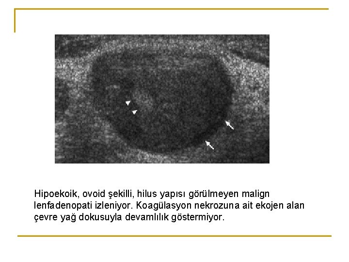 Hipoekoik, ovoid şekilli, hilus yapısı görülmeyen malign lenfadenopati izleniyor. Koagülasyon nekrozuna ait ekojen alan Hipoekoik, ovoid şekilli, hilus yapısı görülmeyen malign lenfadenopati izleniyor. Koagülasyon nekrozuna ait ekojen alan