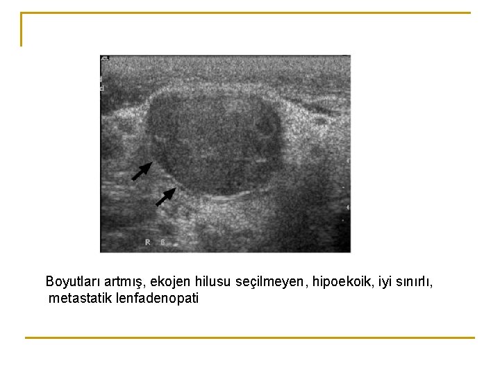 Boyutları artmış, ekojen hilusu seçilmeyen, hipoekoik, iyi sınırlı, metastatik lenfadenopati Boyutları artmış, ekojen hilusu seçilmeyen, hipoekoik, iyi sınırlı, metastatik lenfadenopati