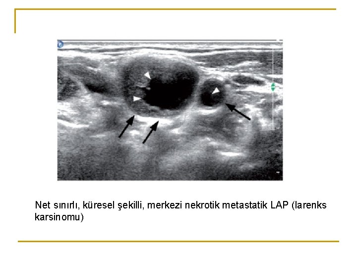 Net sınırlı, küresel şekilli, merkezi nekrotik metastatik LAP (larenks karsinomu) Net sınırlı, küresel şekilli, merkezi nekrotik metastatik LAP (larenks karsinomu)