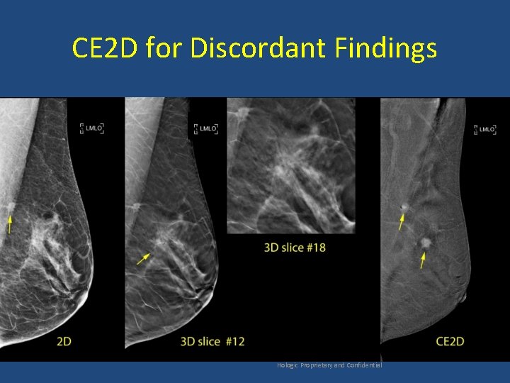 CE 2 D for Discordant Findings Hologic Proprietary and Confidential 