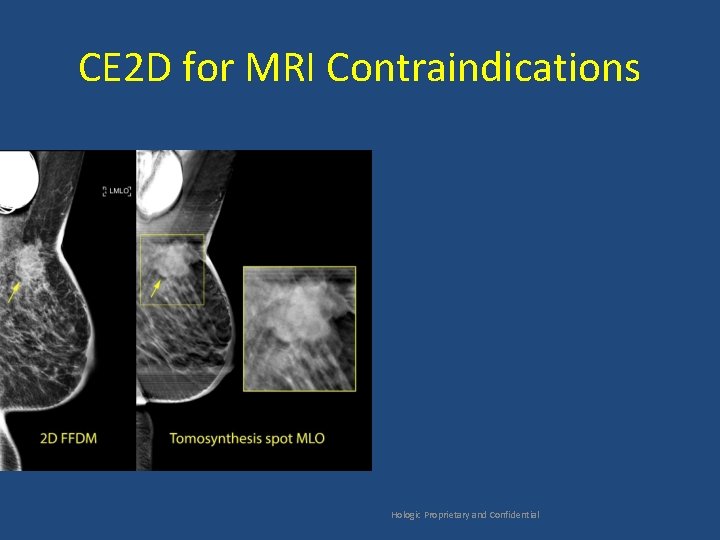 CE 2 D for MRI Contraindications Hologic Proprietary and Confidential 