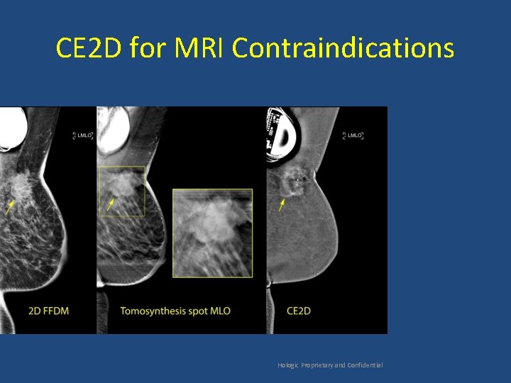 CE 2 D for MRI Contraindications Hologic Proprietary and Confidential 