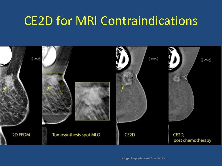 CE 2 D for MRI Contraindications Hologic Proprietary and Confidential 