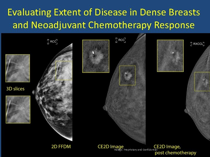 Evaluating Extent of Disease in Dense Breasts and Neoadjuvant Chemotherapy Response Hologic Proprietary and