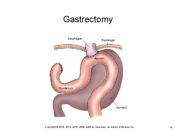 Gastrectomy 10 Copyright © 2016, 2013, 2010, 2006, 2002 by Saunders, an imprint of