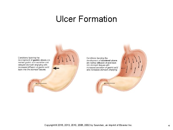 Ulcer Formation 4 Copyright © 2016, 2013, 2010, 2006, 2002 by Saunders, an imprint