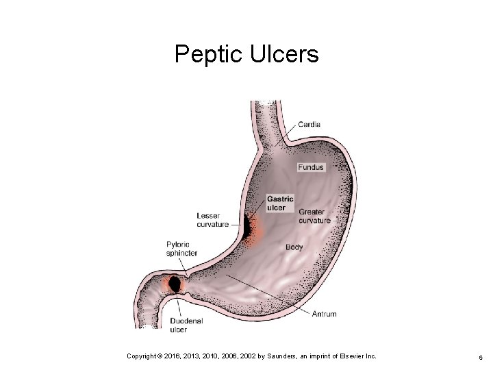 Peptic Ulcers 5 Copyright © 2016, 2013, 2010, 2006, 2002 by Saunders, an imprint