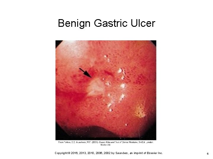 Benign Gastric Ulcer 6 Copyright © 2016, 2013, 2010, 2006, 2002 by Saunders, an