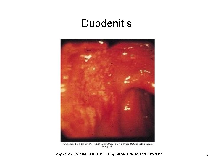 Duodenitis 7 Copyright © 2016, 2013, 2010, 2006, 2002 by Saunders, an imprint of