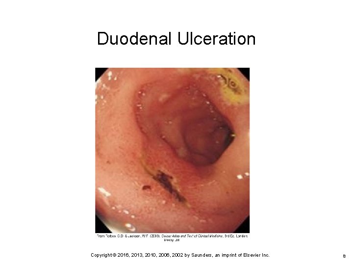 Duodenal Ulceration 8 Copyright © 2016, 2013, 2010, 2006, 2002 by Saunders, an imprint