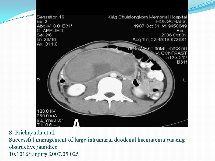 S. Prichayudh et al. Successful management of large intramural duodenal haematoma causing obstructive jaundice