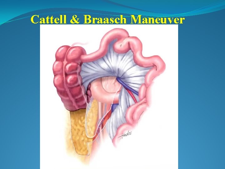 Cattell & Braasch Maneuver 