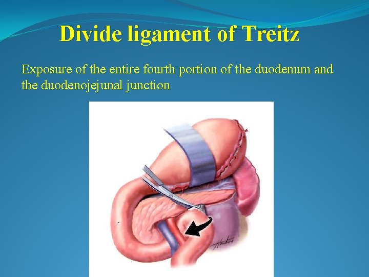 Divide ligament of Treitz Exposure of the entire fourth portion of the duodenum and