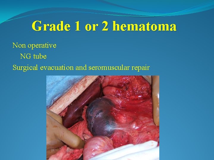 Grade 1 or 2 hematoma Non operative NG tube Surgical evacuation and seromuscular repair