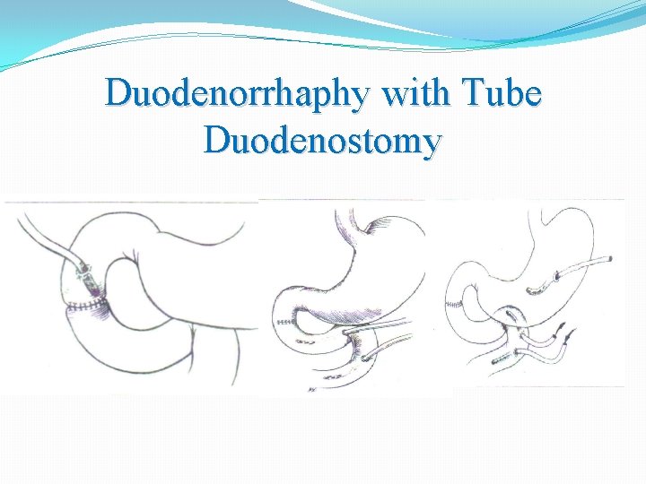Duodenorrhaphy with Tube Duodenostomy 