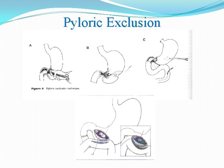 Pyloric Exclusion 