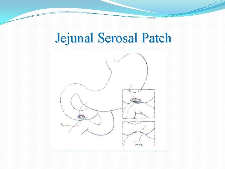 Jejunal Serosal Patch 