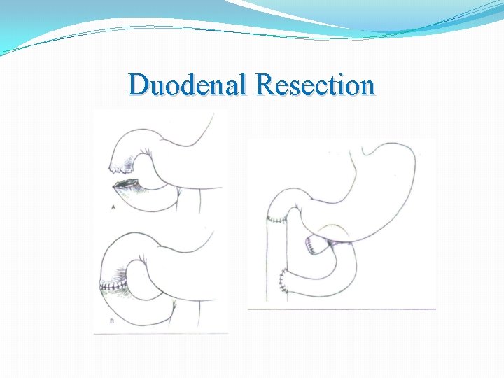 Duodenal Resection 