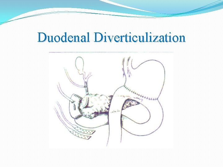 Duodenal Diverticulization 