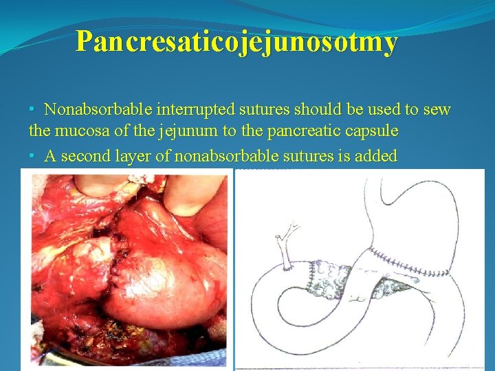 Pancresaticojejunosotmy • Nonabsorbable interrupted sutures should be used to sew the mucosa of the