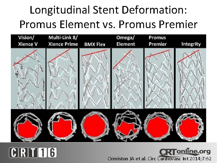 Longitudinal Stent Deformation: Promus Element vs. Promus Premier Ormiston JA et al. Circ Cardiovasc