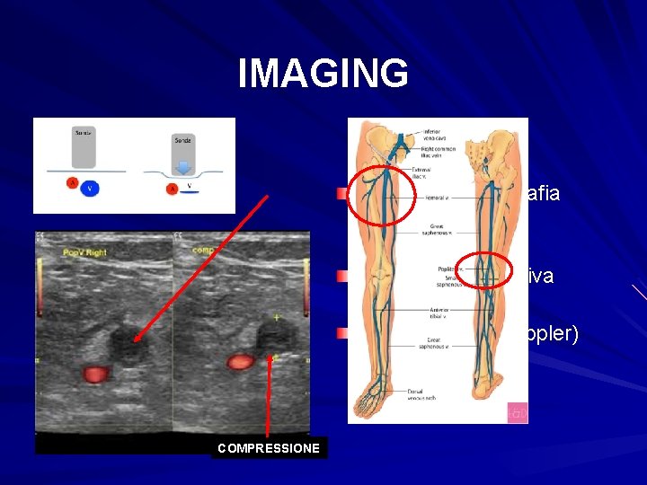 IMAGING CUS (ultrasonografia compressiva semplificata) CCUS (compressiva completa) ECD (ecocolordoppler) COMPRESSIONE 