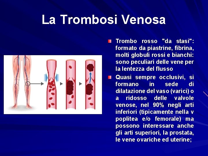 La Trombosi Venosa Trombo rosso "da stasi": formato da piastrine, fibrina, molti globuli rossi