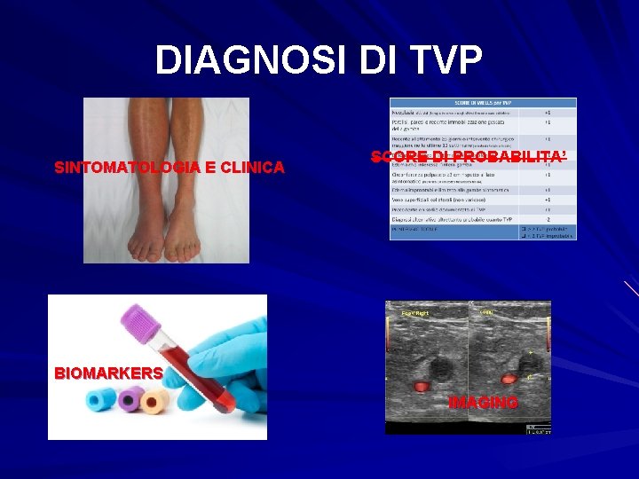 DIAGNOSI DI TVP SINTOMATOLOGIA E CLINICA SCORE DI PROBABILITA’ BIOMARKERS IMAGING 