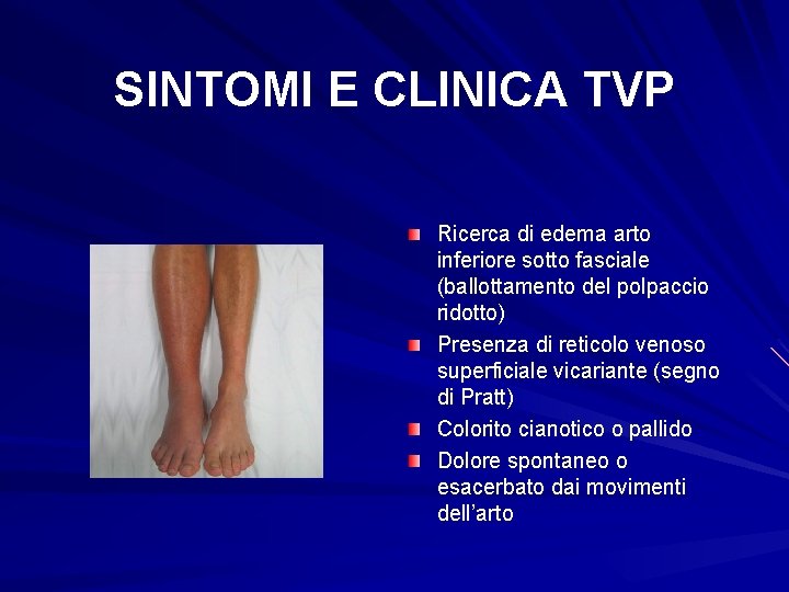 SINTOMI E CLINICA TVP Ricerca di edema arto inferiore sotto fasciale (ballottamento del polpaccio