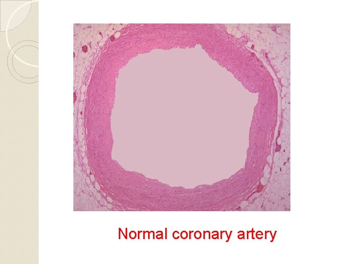 Normal coronary artery 