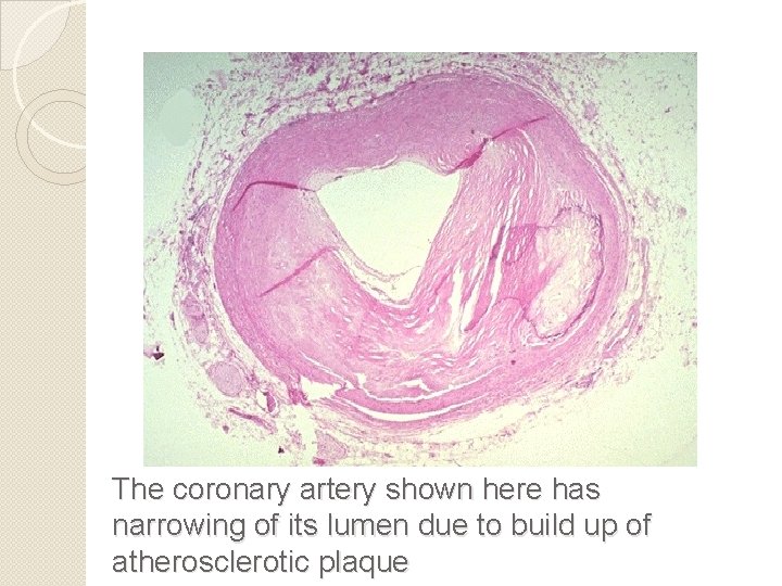 The coronary artery shown here has narrowing of its lumen due to build up