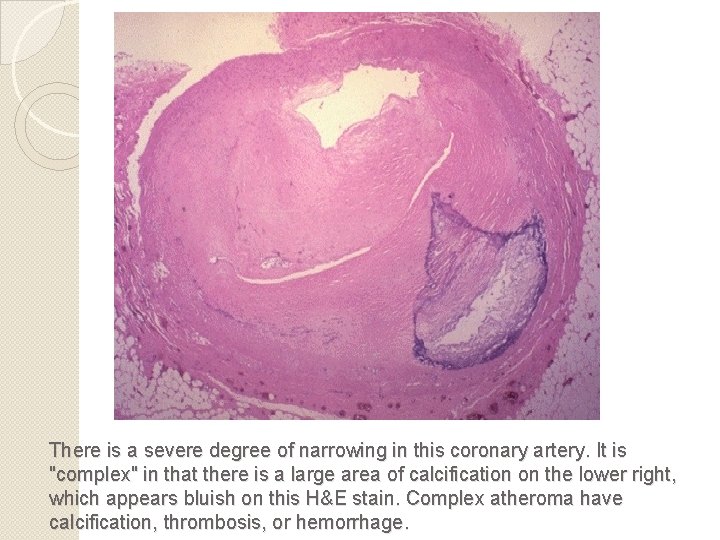 There is a severe degree of narrowing in this coronary artery. It is "complex"