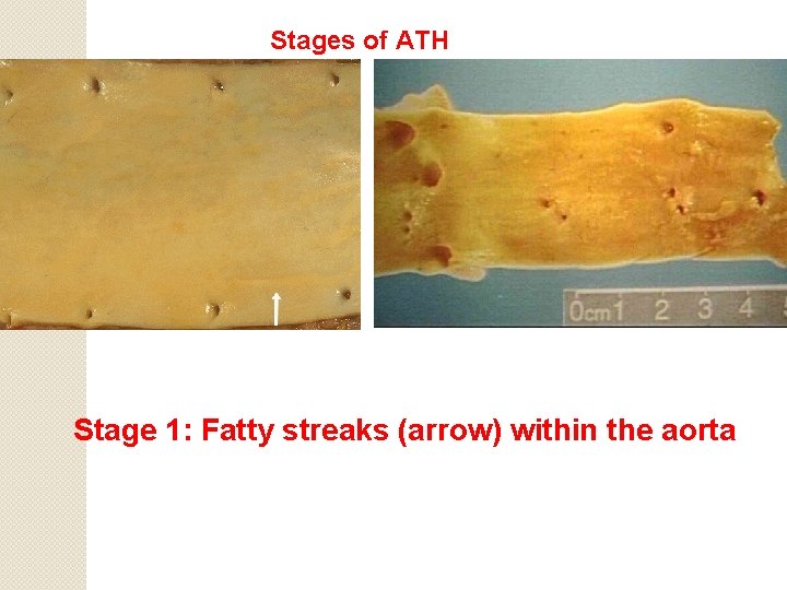 Stages of ATH Stage 1: Fatty streaks (arrow) within the aorta 