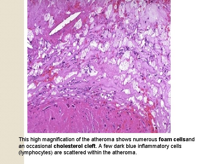 This high magnification of the atheroma shows numerous foam cellsand an occasional cholesterol cleft.