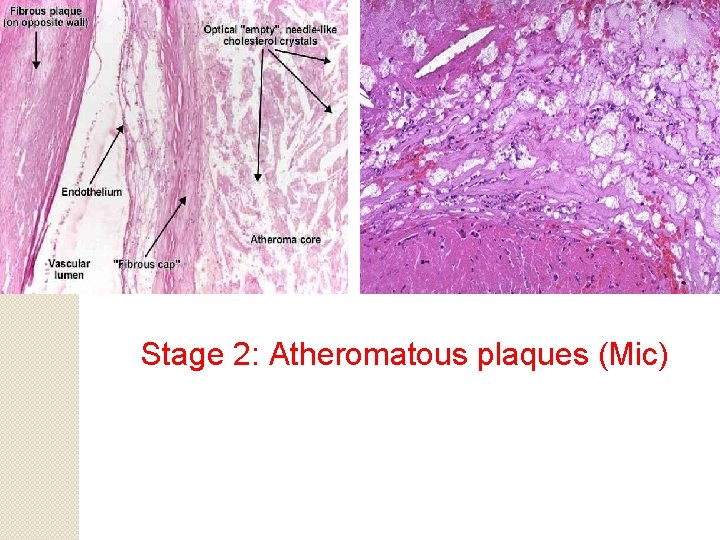 Stage 2: Atheromatous plaques (Mic) 