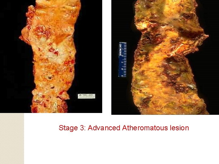 Stage 3: Advanced Atheromatous lesion 