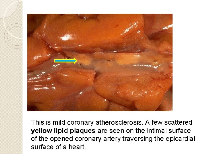 This is mild coronary atherosclerosis. A few scattered yellow lipid plaques are seen on