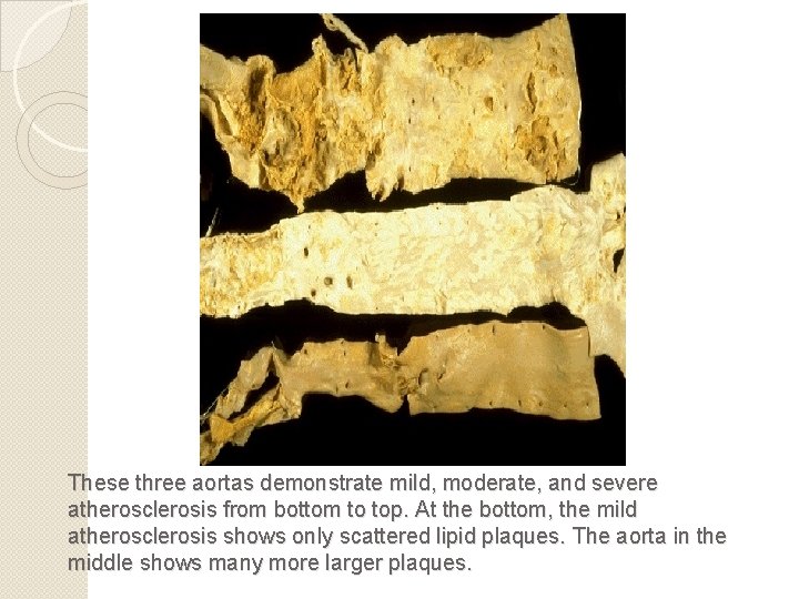 These three aortas demonstrate mild, moderate, and severe atherosclerosis from bottom to top. At