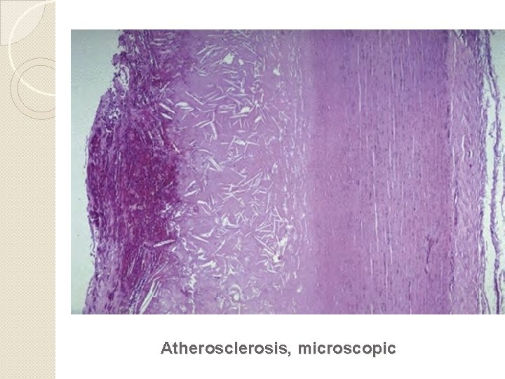 Atherosclerosis, microscopic 