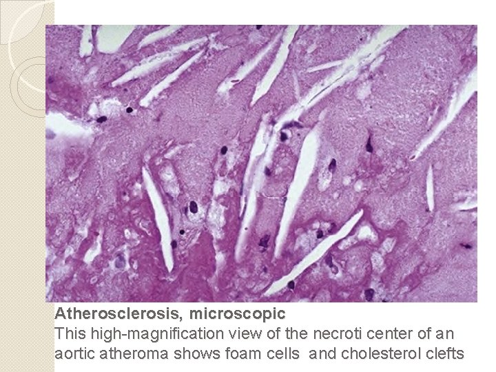 Atherosclerosis, microscopic This high-magnification view of the necroti center of an aortic atheroma shows