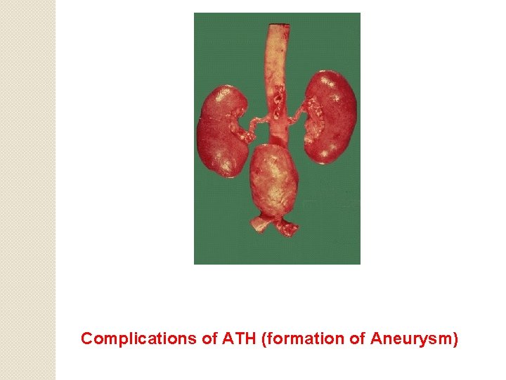 Complications of ATH (formation of Aneurysm) 