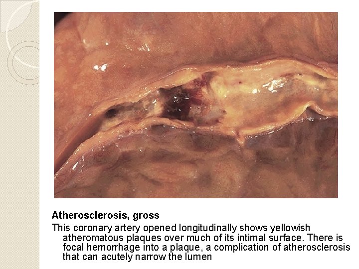 Atherosclerosis, gross This coronary artery opened longitudinally shows yellowish atheromatous plaques over much of