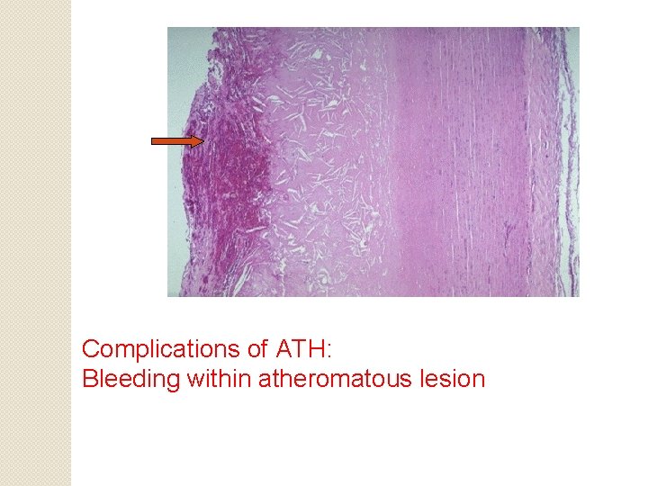 Complications of ATH: Bleeding within atheromatous lesion 