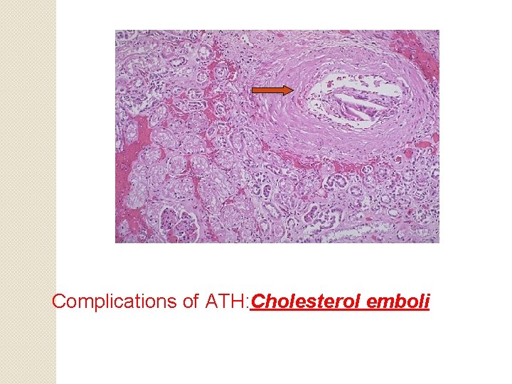 Complications of ATH: Cholesterol emboli 