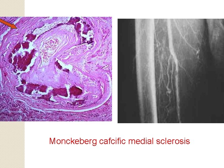 Monckeberg cafcific medial sclerosis 