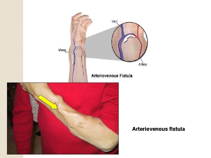 Arteriovenous fistula 