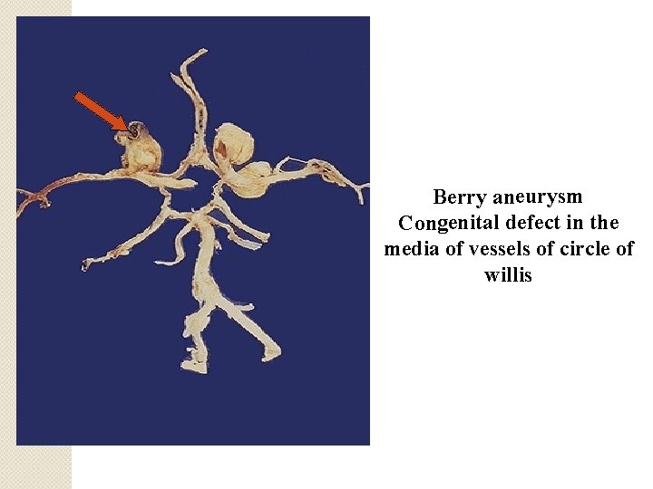 Berry aneurysm Congenital defect in the media of vessels of circle of willis 