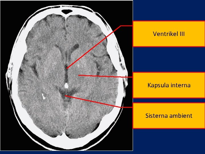 Ventrikel III Kapsula interna Sisterna ambient 