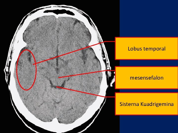 Lobus temporal mesensefalon Sisterna Kuadrigemina 